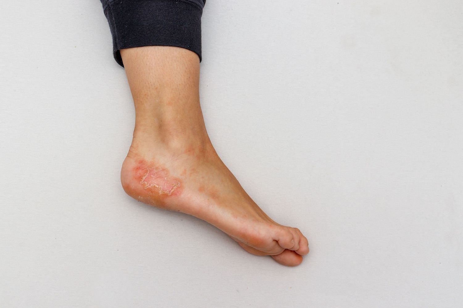 Dyshidrotic-eczema (Image via Getty Images)